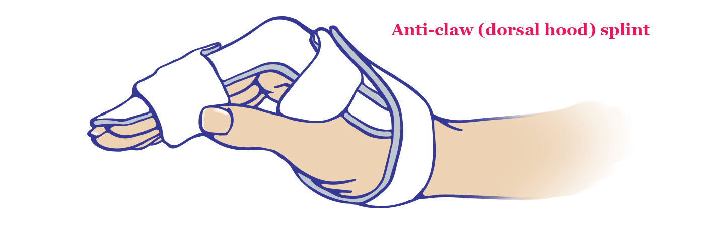 Dorsal Hood (Anti-Claw) Splint