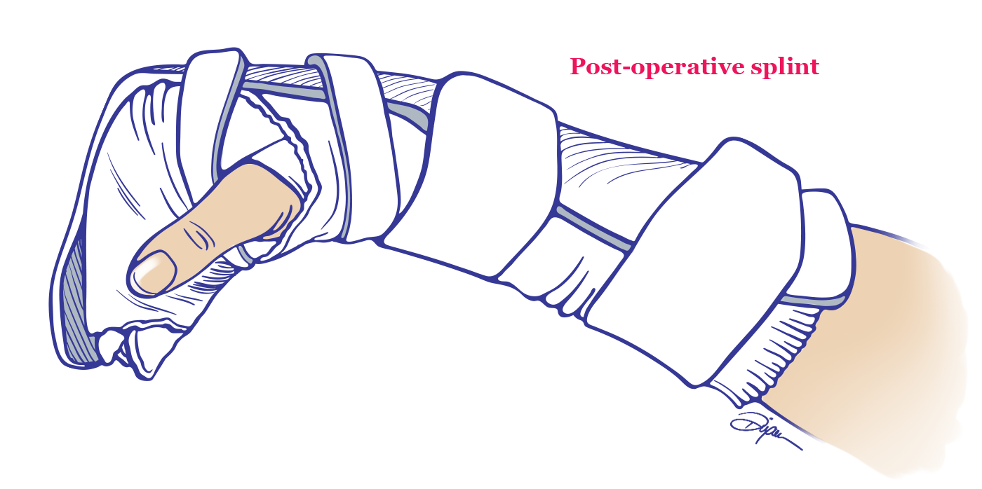 Post-Operative Splint