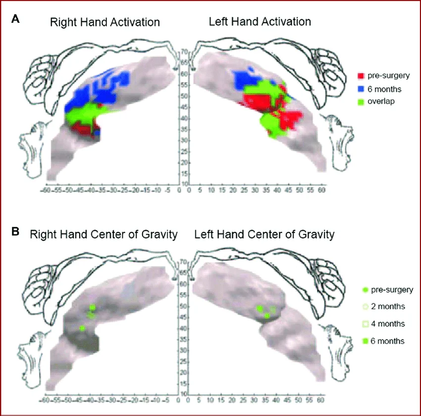 Cortical plasticity induced by bilateral hand transplantation in an amputee — fMRI study figure