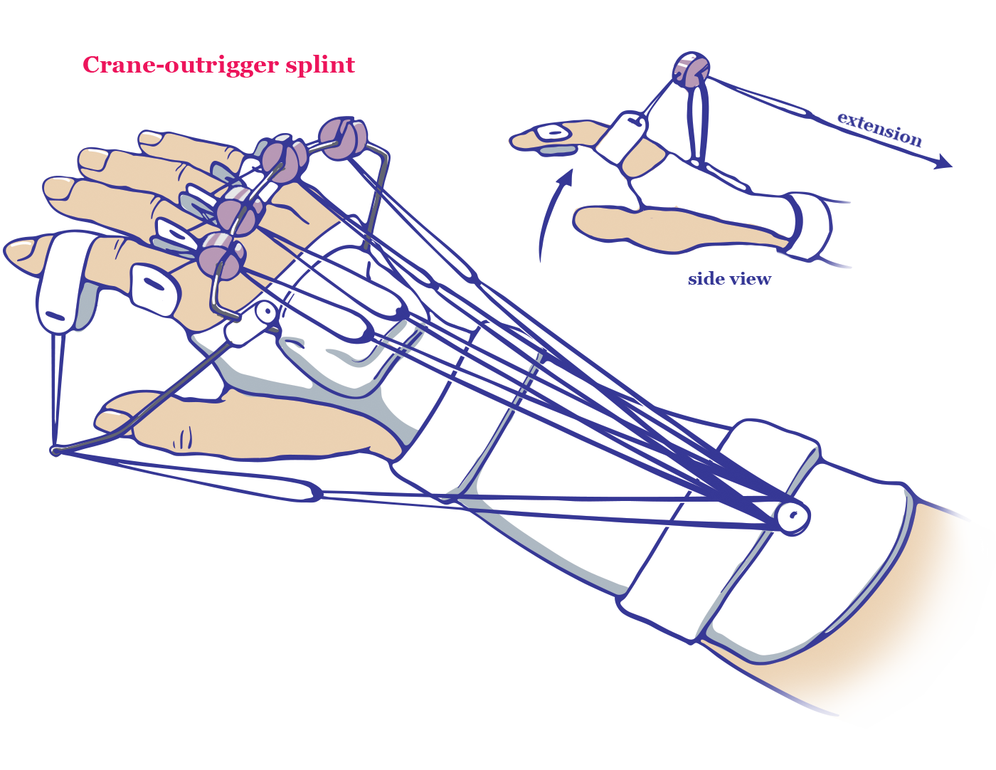Crane Outrigger Splint