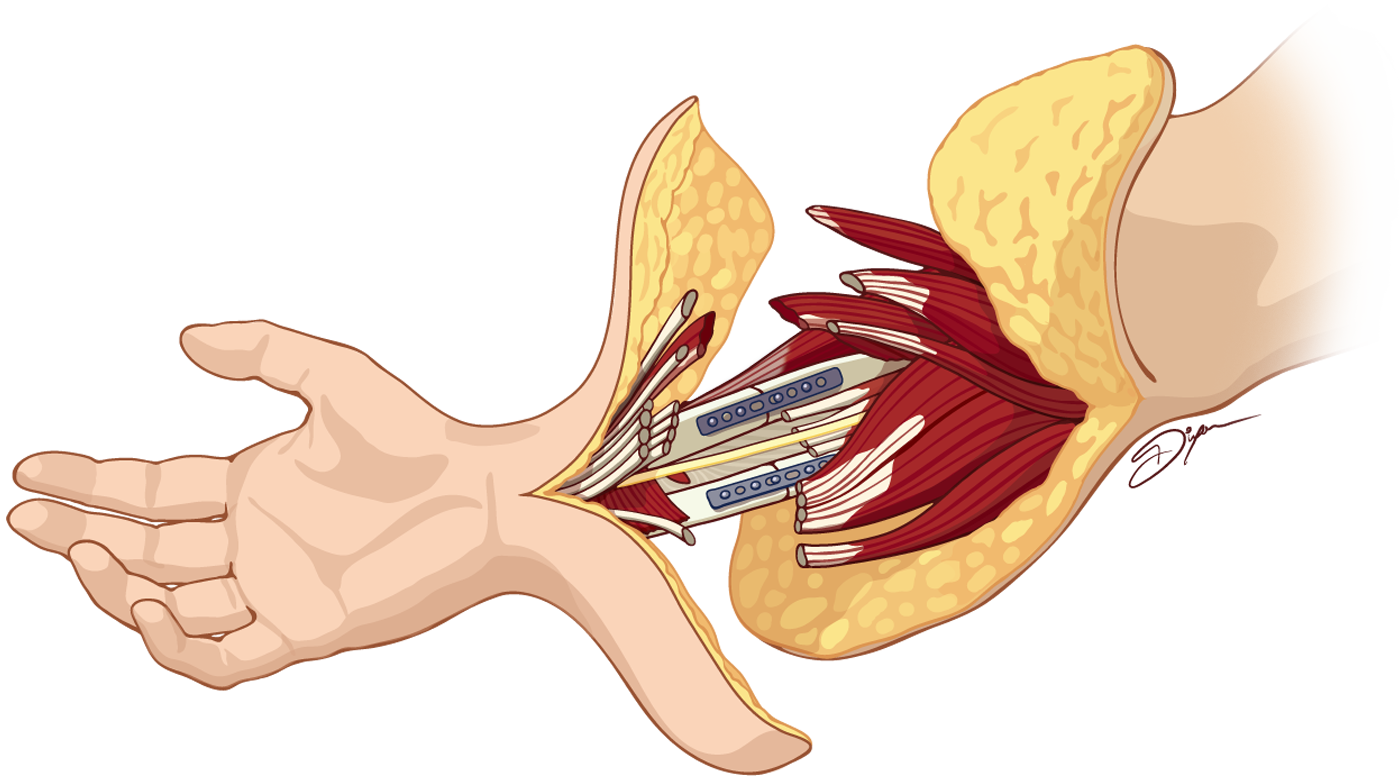 Hand transplant illustration